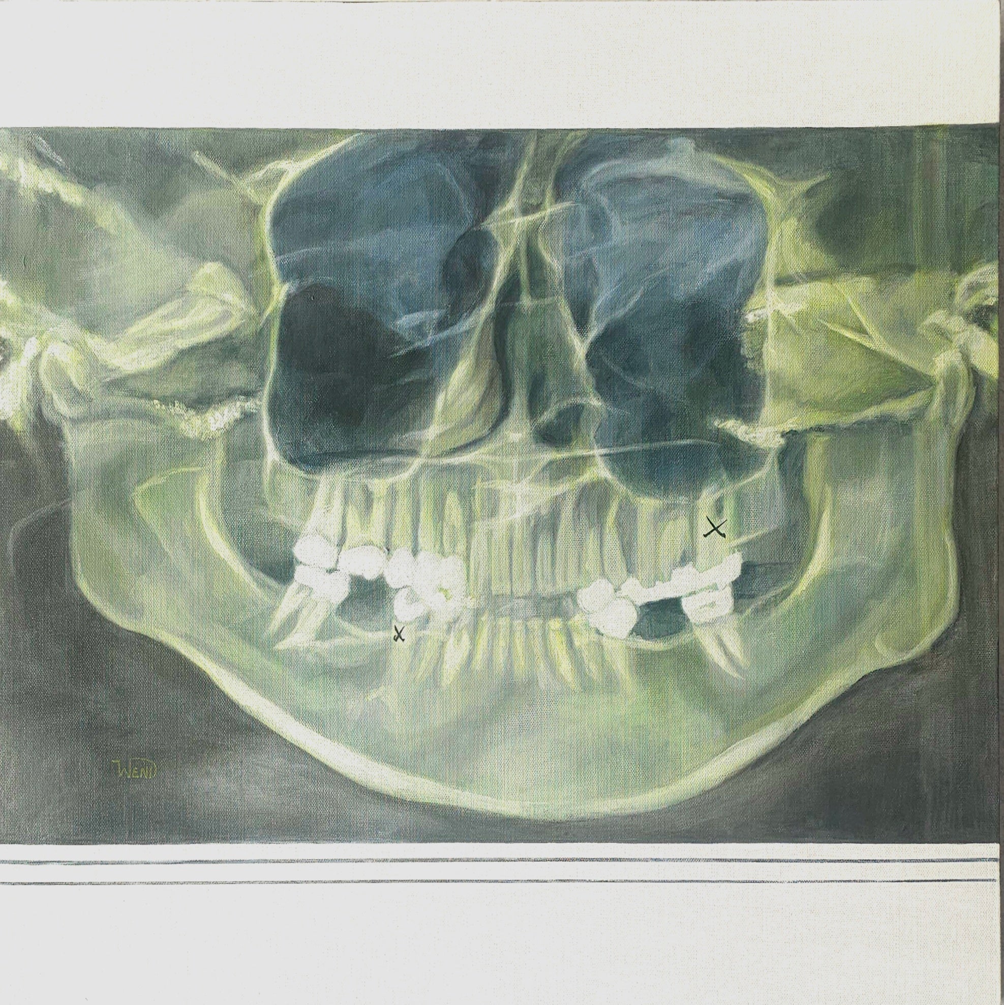 An X-ray style artwork depicting a human skull and teeth in greenish-gray and black tones, shown against a white border background.